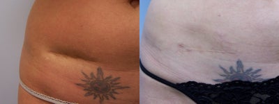 Scar Revision with fat transfer - 
	Patient had fat transfer placed under tissue on scar to increase volume and camoflauge scar.
