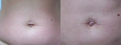Umbilicoplasty to remove lose skin around belly button - Umbilicoplasty was performed in order to remove excess skin around belly button.