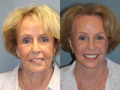 LiteLift on 82-year-old Woman - This 82-year-old woman had a LiteLift&trade; by Dr. Horowitz.&nbsp;