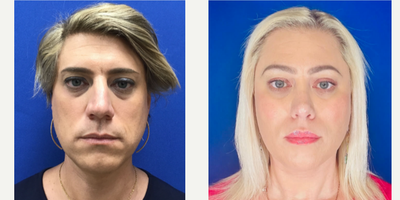 35-44 year old transgender woman treated with Revision Rhinoplasty, Rhinoplasty, Septoplasty - 35 to 44 year-old female patient is 2 years post-op from Facial Feminization surgery. Her procedures included: Septorhinoplasty Revison (open) with Cartilage Grafts and Weirs, Thyroid Cartilage Shave and Voice Feminization, Modified Coronal Forehead Lift, Orbital Bony Contouring, Cheek Implants (small)and Subnasal Lip Lift with Fat Augmentation to Lips.