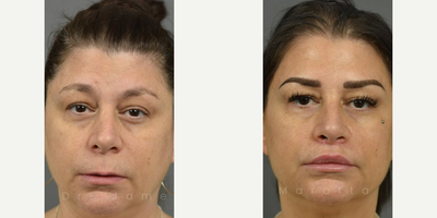 Woman treated with Revision Rhinoplasty - After getting great results from a rhinoplasty 8 months ago, our patient got a surgical lip lift. At just 6 weeks post-op.