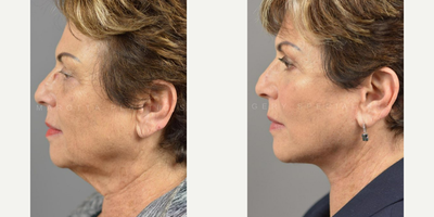 Woman treated with Facelift - The first facelift on record dates back to 1901. In the early days of facial plastic surgery, only the skin was addressed which left many with that pulled look that has been associated with the facelift for far too long. Facial Rejuvenation specialists, like Dr. James Marotta, are now using advanced techniques, like the Deep Plane Facelift, that include the SMAS, or muscle of the face, deep below the skins surface, to provide a subtle, natural result.This procedure is a fantastic option for restoring and rejuvenating a patient's complexion (without looking like they underwent major surgery). This is just one of the facial techniques Dr. Marotta offers to turn back the clock on a patient's appearance and create natural-looking results.