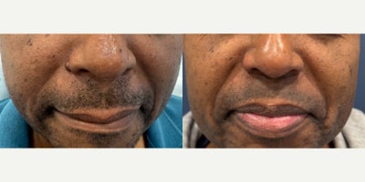 35-44 year old man treated with Mole Removal - This patient underwent facial mole removal on the right nostril which was performed at the office under local anesthesia.The scars will continue to fade over time.