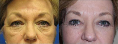55-64 year old woman treated with Eyelid Surgery - Had excess skin of the upper and lower eyelids removed.