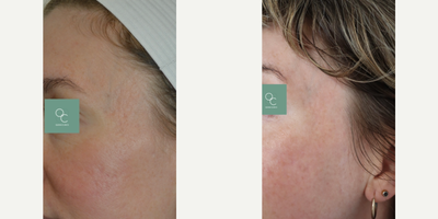 35-44 year old woman treated with eMatrix - Before and after 3 sessions of Sublative fractional radiofrequency