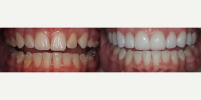 Woman treated with Tooth Repair - Woman treated with Tooth Repair using 10 minimal/no-prep veneers for smile enhancement. She previously had Invisalign but was still dissatisfied with the appearance of her teeth.