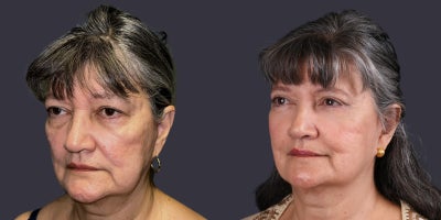 65-74 year old woman treated with Eyelid Surgery, CO2 Laser, Facial Fat Transfer, ActiveFX - This 69 year old woman presented requesting improvement in her tired eyes. She had upper eyelid blepharoplasty, lower eyelid blepharoplasty with fat transposition, and CO2 laser resurfacing around the eyes.