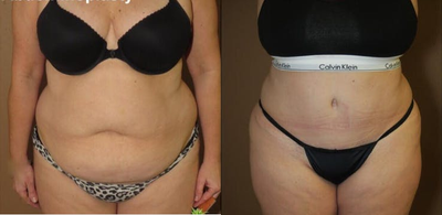 Woman treated with Tummy Tuck - Woman treated with Tummy Tuck