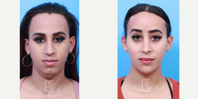 25-34 year old transgender woman treated with Facial Feminization Surgery, Transgender Facial Feminization Surgery - Facial feminization surgery provides elegant facial transformation while keeping characteristics important to the individual. Careful pre-operative analysis and surgical planning leads to successful surgical execution. In this patient, I performed surgery on her hairline, brow, frontal (forehead and orbital and nasal) bone, temples, nose, nostrils, chin, jaw, neck, cheeks.