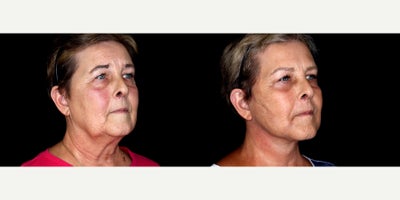 65 year old woman treated with Facelift, Neck Lift, Eyelid Surgery, Cheek Lift, Facial Fat Transfer - 65 year old woman treated with Facelift, Neck Lift, Eyelid Surgery, Cheek Lift, Facial Fat Transfer. Photos depict before and 3 months after surgery.