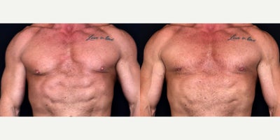 48 male treated with Gynecomastia Surgery - 48 male treated with Gynecomastia Surgery. Photos depict before and 1 month after surgery.