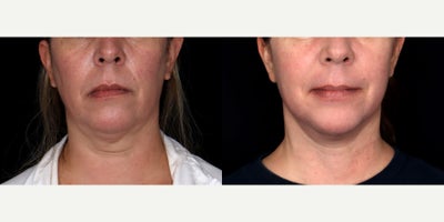 46 year old woman treated with Lower Facelift, Neck Lift - 46 year old woman treated with Lower Facelift and Neck Lift. Photos depict before and 3 months after surgery.