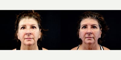 57 year old woman treated with Thread Lift - 57 year old woman treated with Thread Lift. Photos depict before and 1 month after 8 Silhouette Instalift Sutures.