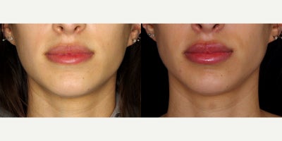 24 year old woman treated with Restylane Kysse - 24 year old woman treated with Restylane Kysse. Photos depict before and 3 weeks after one syringe to the lips.