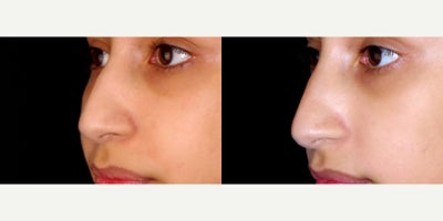 21 year old woman treated with Restylane Lyft - 21 year old woman treated with Restylane Lyft. Photos depict before and 1 month after 1 syringe was injected to her nose (liquid rhinoplasty)