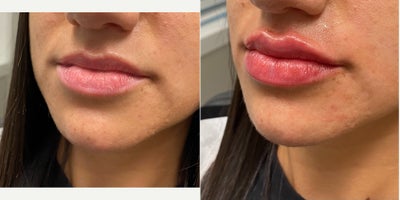 25-34 year old woman treated with Restylane Kysse - Restylane Kysse lip fillers with Dr. Wise at the Wise Center for Plastic Surgery in Wayne, NJ to create a plumped up and symmetrical look!