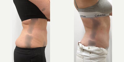 35-44 year old woman treated with CoolSculpting Elite - Patient wanted to reduce the appearance of lower belly fat.