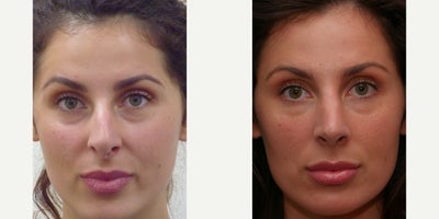 Rhinoplasty - Eyes and face, with hanging uneven columella