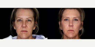 54 year old woman treated with Eyelid Surgery, Cheek Lift - 54 year old woman treated with Eyelid Surgery, Cheek Lift. Photos depict before and 6 months after surgery.