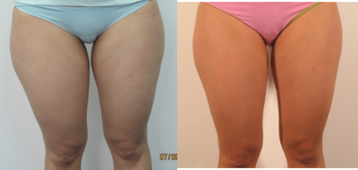 TriPollar - 
	Thigh skin tightening and cellulite reduction after 8 treatments. Reduction of 4.2 cm in left thigh circumference. Reduction of 4.3 cm in right thigh circumference. Photos supplied by manufacturer, Pollogen Ltd, All Rights Reserved.
