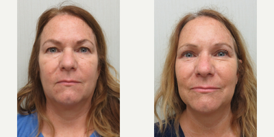 45-54 year old woman treated with Brow Lift, Eyelid Surgery - This patient underwent an endoscopic browlift and an upper lid blepharoplasty to soften the heaviness of her brow.