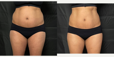 45-54 year old woman treated with Emerald Laser NOT Zerona this is the newest low level light fat reduction laser by Erchonia - Real Self does not have Emerald Laser Treatment as an option but Zerona is the previous version with red light this is the newer 25% more effective green diode laser.Patient had 10 total treatments over ~ 5 week period. Typically 2 sessions/week.