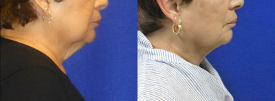 75 and up year old woman treated with CoolMini - Single day treatment for fat reduction and skin tightening at the chin and neck with CoolMini. Results were achieved in 4 months. To see results after 1 month, view the additional before and afters for this treatment.
