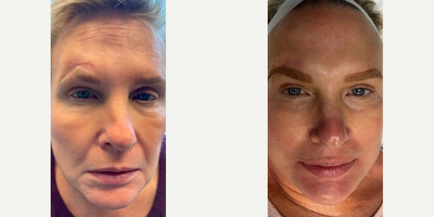 Woman treated with Microneedling RF - This incredible journey with our lovely patient showcases the power of SylfirmX micro needling. From a traumatic scar to a radiant glow, we've not only improved the contour but also elevated the brow for perfect symmetry.