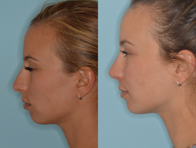 25-34 year old woman treated with Septoplasty - A doctorpresents a patient with a deviated nose where an advanced technique was utilized called an extracorporeal septoplasty. In this technique the entire septum is removed and reconstructed to help provide for the best improvement in the deviation of the nose.