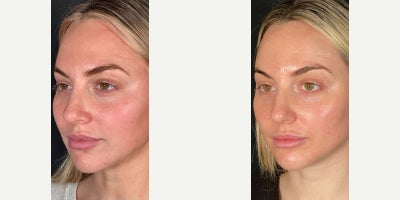 25-34 year old woman treated with Sculptra, Microneedling - Wondering how she got that glow? Microneedling with Sculptra is giving beautiful results! Microneedling opens the channels on the skin to allow topical Sculptra to penetrate, leaving you with naturally glowing skin.
