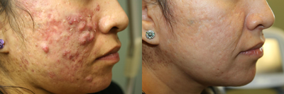 Aerolase Neo Acne Treatment - Acne treated with the Aerolase Neo.