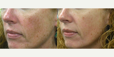 50 year old woman treated with a Vi Peel - This patient was concerned with sun damage and freckling on her face. She had 1 ViPeel