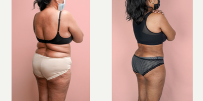 55-64 year old woman treated with Liposuction, Tummy Tuck - This lovely patient requested help in improving her shape and removing the sagging skin from her abdomen. She was able to turn back the clock and look 30 years younger with a combination of tummy tuck and 360 liposuction.
