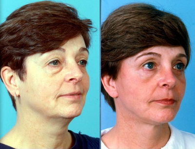 Eyelid Surgery - Eyelid Surgery