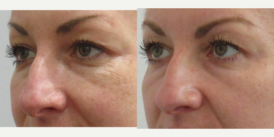 35-44 year old woman treated with ReFirme - This patients concerns were age lines and broken capilarries. Over the course of two years, they have had a total of four appointments encompasing of Sublative Radio Frequency, Refirme, and IPL.