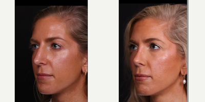 18-24 year old woman treated with Revision Rhinoplasty - Revision rhinoplasty B&A with rib cartilage grafting