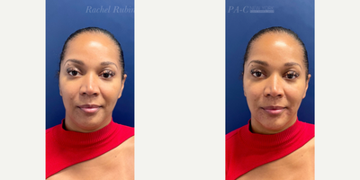 25-34 year old woman treated with Restylane, Restylane Defyne, Restylane Lyft, Voluma - A woman in her 30s, after treatment of the chin, smile lines, and chin shadow.