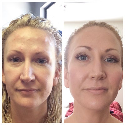35-44 year old woman treated with Vivace, Botox, and Radiesse - Vivace, Botox, and Radiesse