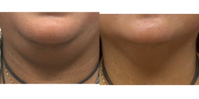 45-54 year old woman treated with Skin Tightening, Endolift - 45 year old desiring laser lipolysis and skin tightening for removal double chin and defining jaw line