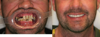 32 year old male treated with All-on-4 Dental Implant Procedure - 32 year old male treated with All-on-4 Dental Implant Procedure