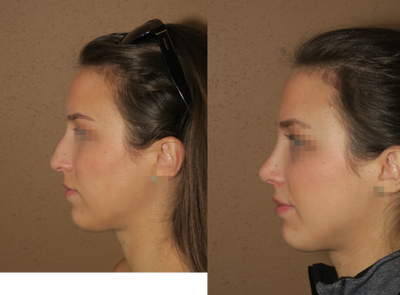 25-34 year old woman treated with Rhinoplasty - rhinoplasty