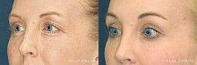 Brow Lift - Patient received endoscopic brow lift and mid face lift