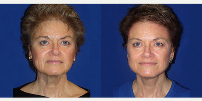 Woman treated with Facelift - Woman treated with Facelift
