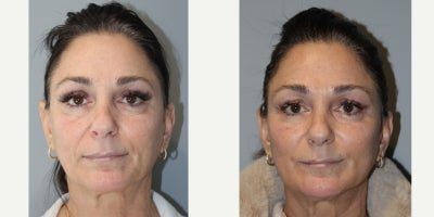 55-64 year old woman treated with Thread Lift - PDO threads Midface and Lowerface, Lifted elegance!