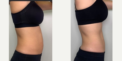 25-34 year old woman treated with Eon - Our patients goals were to reduce some of her stubborn belly fat