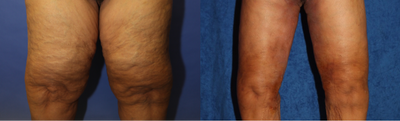 35-44 year old woman treated with Thigh Lift - This patient was unsatisfied with the size of her thighs so she underwent a medial thigh lift.