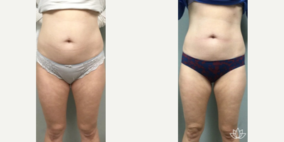 Woman treated with UltraShape - Our Ultra Shape sessions that can provide jaw-dropping results like these!