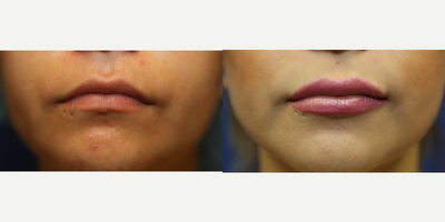 25-34 year old woman treated with Lip Implants - The Permalip is a silicone lip implant that permanently augments the lips. There's no need to return to the office for lip fillers every 6-8 months.