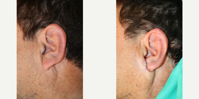 55-64 year old man treated with Earlobe Surgery - This gentleman is in his late 50s has always been self-conscious about the size of his earlobes. He presents desiring earlobe reduction surgery. While there are various ways to perform this procedure, in this particular case, successive portions of his ear lobes were removed until a more normal and tidy ear lobe was created.  Incisions similar to those for a facelift were used to hide the scars.  These pictures are before and immediately following the surgery. His ear lobes have swelling due to retained local anesthesia as well as swelling from the procedure itself. This was performed under local anesthesia solely and he tolerated this very well. The stitches will stay in for seven days.