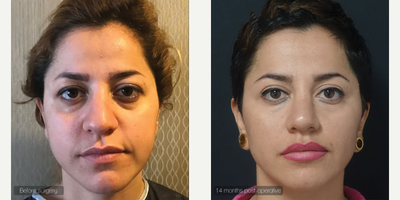 35-44 year old woman treated with Teosyal Redensity II - 35-44 year old woman treated with Teosyal Redensity II